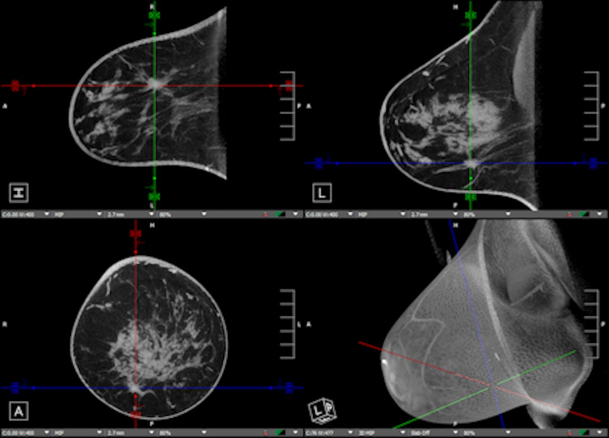 Diagnostic Breast Imaging 第2版 Diagnostic Breast Imaging: Mammography, Sonography, MRI and
