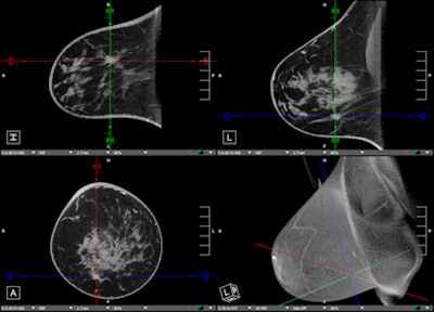 Koning positions breast CT scanner as 1-stop diagnostic shop