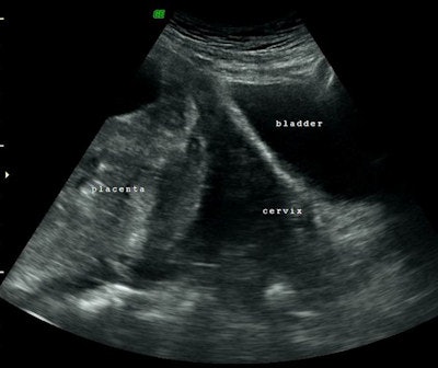 Top: Ultrasound shows invasive placenta. Bottom: MRI shows major placenta previa. All images courtesy of Dr. Jamal Alkoteesh.
