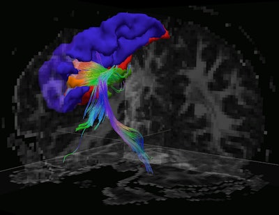 The figure shows the inverse relationship between postconcussive symptoms and cortical thickness. Blue regions indicate where this relationship was statistically significant. Image courtesy of the University of Vermont.