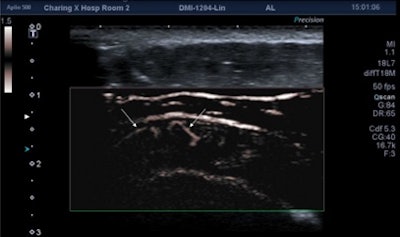 Acute case of supraspinatus tendinitis. SMI shows abnormal microvasculature (arrows) within the inflamed tendon. Image courtesy of Dr. Adrian Lim.