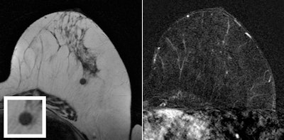 T2-weighted turbo spin-echo MR image and magnification view (left) show a round mass as the correlate of the mammographic finding at 1 o'clock in the left breast. The mass is isointense with discrete internal septations. Subtracted T1-weighted gradient-echo MR image (right) obtained after administration of contrast shows no enhancement of the lesion. Ultrasound-guided core needle biopsy was performed, and histologic examination showed a sclerosed fibroadenoma.