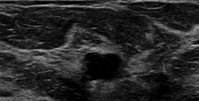 B-mode ultrasound scan shows hypoechoic mass with ill-defined margins in left breast at 1 o'clock position.