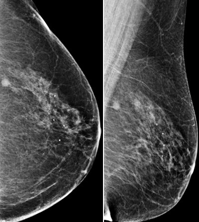 Images are of a 69-year-old postmenopausal woman who had mammographic screening. Screening mammograms (left craniocaudal and left mediolateral oblique views, respectively) show a mass with ill-defined margins in the posterior third of the left breast at 1 o'clock position. All images courtesy of RSNA.