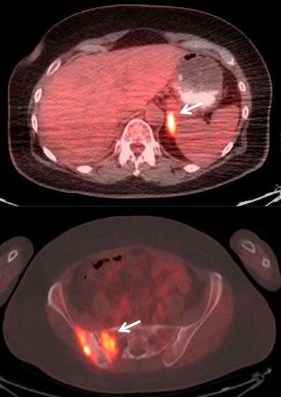 Fused PET/CT images of a 60-year-old woman with stage IIB adenocarcinoma of the right upper lobe of the lung. A routine fifth follow-up scan was requested without prior clinical suspicion of lung cancer recurrence one year after completion of primary treatment. PET/CT shows hypermetabolic, metastatic multiple osseous (arrow) and left adrenal lesions (arrow). The patient was started on a new chemotherapy regimen after the study. Images courtesy of JNM.