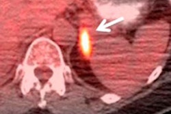 2015 02 19 17 31 35 343 Petct Fifth Image Jnm 200