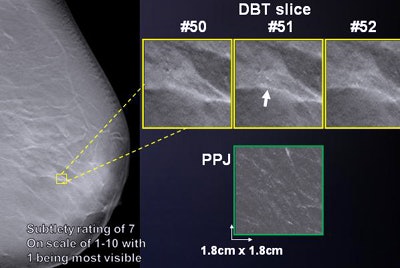 DBT CAD detected a microcalcification, while the planar projection CAD image shows no abnormality. Image courtesy of Ravi Samala, PhD.