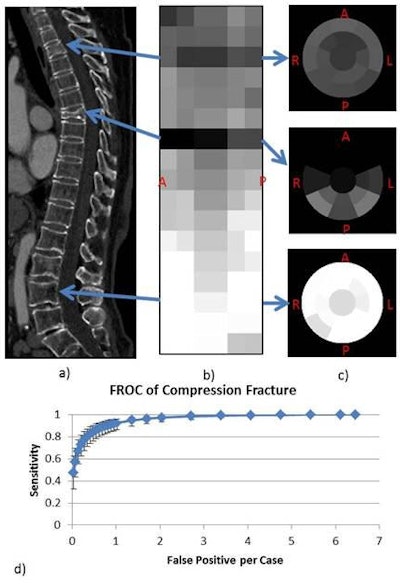83-year-old woman with compression fracture at T3 and T7. Curved sagittal reformation; sagittal view of stacked height compasses at T3, T7, and L3 (normal); and free-response receiver operator characteristics (FROC) curve. Image courtesy of Jack Yao, PhD, and Dr. Ronald Summers, PhD.