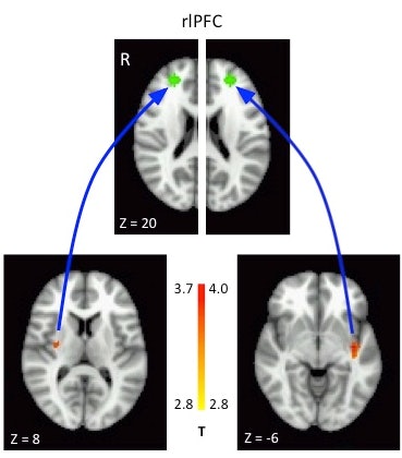 The comparison of functional MR images shows regions of interest in the rostrolateral prefrontal cortex (top) and the connected areas in the striatum/insula (bottom images). Blue arrows indicate how the regions influence each other. Image courtesy of Dr. Andrew Kayser, PhD.
