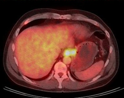 Images show carcinoma at the esophagogastric junction before therapy (pre therapy) and after two cycles of chemotherapy (post therapy). The image after two cycles of chemotherapy demonstrates complete metabolic response. Image courtesy of Dr. Gerald Antoch.