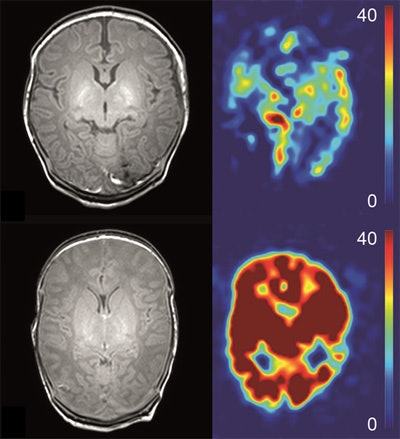 Anatomical (T1-weighted) images and arterial spin labeling perfusion images of two infants. Perfusion quantification is denoted by a color bar. The upper row shows the images of an infant with hypoxic-ischemic encephalopathy (HIE) a favorable outcome. The lower row shows the images of an infant with HIE and adverse outcome. Note the marked higher perfusion in the entire brain of the infant with adverse outcome. Images courtesy of Dr. Jeroen Hendrikse and Dr. Jill B. De Vis.