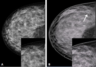 A 48-year-old woman with heterogeneously dense breasts. A: Negative craniocaudal mammogram with electronic magnification of the external area. B: Craniocaudal digital breast tomosynthesis image (Giotto Tomo, IMS, Bologna, Italy) clearly shows a spiculated mass (arrow). Both insets show magnification. Pathology: 12-mm invasive ductal cancer. Image courtesy of Francesco Sardanelli.