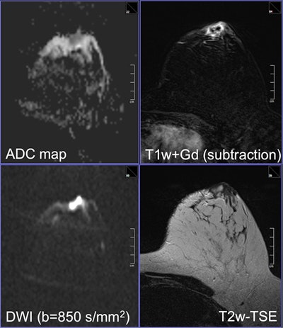 A rim-enhancing mass on contrast-enhanced subtraction. The unenhanced scan shows a high signal intensity of the whole lesion on the diffusion-weighted image, higher than normal cancer. It corresponds to a restricted diffusion of the whole lesion and intermediate high signal intensity on the T2-weighted turbo spin-echo scan. The finding is typical for an abscess: If this were a cancer, the central necrosis should not show restricted diffusion or at least the restricted diffusion should correspond with the enhancement. It is a nice example how DWI (and subsequently unenhanced MRI) may lead to a better diagnosis compared with contrast-enhanced imaging. Images courtesy of Dr. Pascal Baltzer.