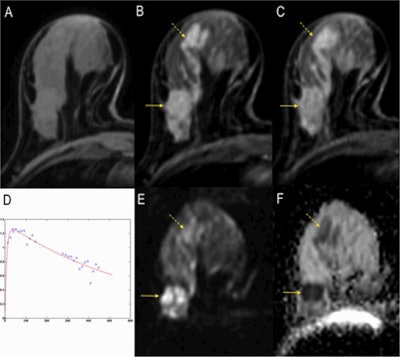 A full examination at 3 tesla. A, B, and C: Precontrast T1-weighted imaging, early and delayed postcontrast scans depicting a mass (invasive ductal carcinoma, arrow) and associated clapped segmental nonmass enhancement (dashed arrow, ductal carcinoma in situ [DCIS]). D: The SI-time curve of the mass, indicating a malignant lesion by washout type 3 curve. E: The DWI image where the cancer lesions can be seen hyperintense similar to contrast-enhanced images. F: The apparent diffusion coeficient (ADC) map where the tumors are indicated by low signal intensity corresponding to typical restricted diffusion. Note that the signal of the invasive cancer is lower than that of the DCIS, confirming the ability of DWI to demonstrate quantitative differences in tissue microstructure not only able to diagnose cancer but also to differentiate invasive from noninvasive cancer. Images courtesy of Dr. Pascal Baltzer.