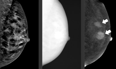 An example of a complete contrast-enhanced spectral mammography (CESM) exam, which consists of a normal mammogram (left), followed by a high-energy image (middle, which is not for diagnostic purposes). These two images are postprocessed to generate the recombined image (right), which is showing areas of enhancement. The arrows indicate the breast cancer. In a CESM exam, only the left and right image are presented to the radiologist. Images courtesy of Dr. Marc Lobbes.
