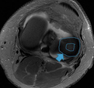 Image shows lateral discoid meniscus. Instead of the normal meniscal shape (triangular in cross-section and C-shaped), it appears in the shape of a disk. Image courtesy of Dr. Gustav Andreisek.