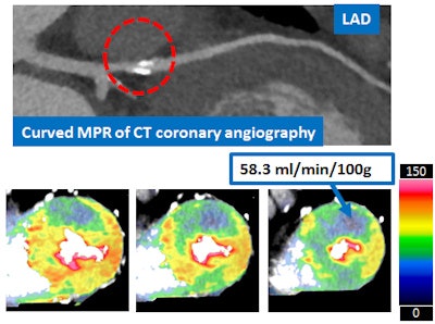 A 61-year-old woman with atypical chest pain. Focal calcification in proximal left anterior descending (LAD) artery precluded assessment of degree of stenosis. Dynamic CT stress myocardial perfusion imaging showed reduced stress perfusion in the anteroseptal wall and apical wall, suggesting LAD stenosis. Invasive coronary angiography demonstrated high-grade stenosis with reduced FFR in the proximal LAD. Image courtesy of Dr. Kakuya Kitagawa.