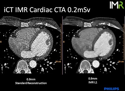 0.2-mSV cardiac CT angiography examination demonstrates standard reconstruction versus iterative model reconstruction (IMR). Image courtesy of Philips Healthcare.