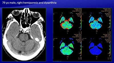There were discordant results with automatically generated perfusion maps in the case of a 79-year-old man presenting with right hemiparesis and dysarthria (above). Manual mapping showed an area of reduced CBV, reduced CBF, and increased MTT in the left pons, suggesting infarction of the pons, but the color map showed only abnormalities, leading to a false negative as confirmed on follow-up CT (below).