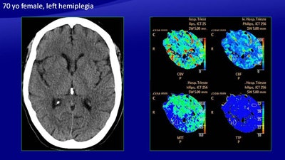 In a 70-year-old woman with left hemiplegia, CT (above) shows a slight hypodensity in the right basal ganglia, a large area of increased MTT, and a smaller area of reduced CBV and CBF. The automatically generated color map depict a large area of ischemic penumbra and a smaller area of infarcted core, which was confirmed on follow-up CT (below). All images courtesy of Dr. Maja Ukmar.