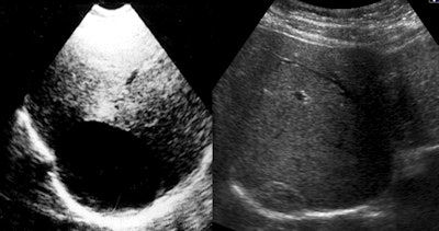 Ultrasound shows a liver CE 1 on the right side before the procedure in 1991 and a solid remnant with 'pseudotumor appearance' -- 23 years after treatment. Images courtesy of Dr. Okan Akhan.