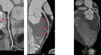 Images are of a study participant with no coronary artery disease (right) and a second participant, his brother (left), who has obstructive coronary disease. Both are cyclists. Images courtesy of Dr. Thijs Braber.