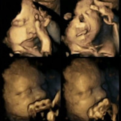 2015 03 23 16 32 32 379 Fetal Ultrasound Smoking 200