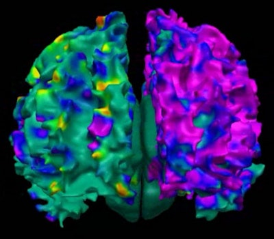 MRI showed the effects of PAH on the developing brain. Image courtesy of the Saban Research Institute of Children's Hospital Los Angeles.