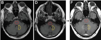 Axial T1-weighted MR images show the posterior fossa at the level of the dentate nucleus. Image B is of a control group patient, while image D is the first MRI exam and F is the last MRI exam of a patient in the contrast group. Regions of interest used to quantify signal intensity are shown as dashed lines for the dentate nucleus (yellow) and pons (red). Images courtesy of Radiology.