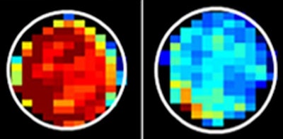 Normal cells (left) have more sugar attached to mucin proteins than do cancerous cells (right). The mucin-attached sugar generated a strong MRI signal (red). Images courtesy of Xiaolei Song, PhD, and Johns Hopkins Medicine.