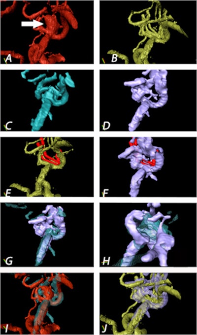 Aneurysm of the medial cerebral artery bifurcation indicated by the white arrow. Precise aneurysm neck visualization in 3D-ioUS and clip segmentation for virtual planning of clipping procedure. A: preclipping rDSA (red); B: postclipping rDSA (green); C: preclipping 3D-ioUS (blue); D: postclipping 3D-ioUS (pink); E: postclipping rDSA with segmented clips (red); F: postclipping 3D-ioUS with segmented clips (red);G-H: coregistration of C+D; I: coregistration of A+C; J: coregistration of B+G.