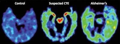 FDDNP-PET images show a normal brain scan (left), a patient with suspected CTE (middle), and an Alzheimer's patient (right). Red and yellow indicate more abnormal brain proteins (tau and amyloid). The suspected person with CTE has high levels of FDDNP signal in the midbrain (red central area) and amygdalae (smaller red areas). In this more advanced case of suspected CTE, the FDDNP signal (yellow/green) is seen throughout the cortex, which is where most of the FDDNP signal is located in the Alzheimer's patient. Images courtesy of PNAS and David Geffen School of Medicine at UCLA.