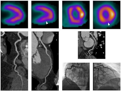 Above, patient whose SPECT exam was read as positive for inferior wall ischemia. However, neither CCTA nor catheter angiography showed evidence of coronary artery disease. Images courtesy of Dr. Felix Meinel.