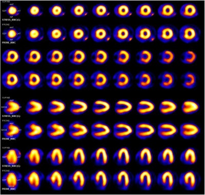 Myocardial perfusion images from normal stress-only study performed on ultralow-dose high-efficiency camera. The top rows are supine images, while bottom rows were acquired in prone position. Radiation effective dose for the study was 0.93 mSv. Images courtesy of the Journal of Nuclear Medicine.