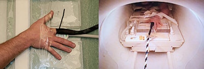 The radiofrequency coil inside the clear housing (top). The MCP joint of interest centered over the bore of the radiofrequency coil (above left). The participant's hand within the imaging magnet (above right). All images courtesy of PLOS One.