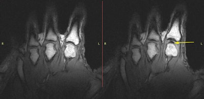 T1 static images of the hand in the resting phase before cracking (left). The same hand following cracking with the addition of a postcracking distraction force (right). Note the dark void (yellow arrow).