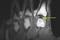 2015 04 14 15 31 21 390 Mri Knuckles Cracking 200