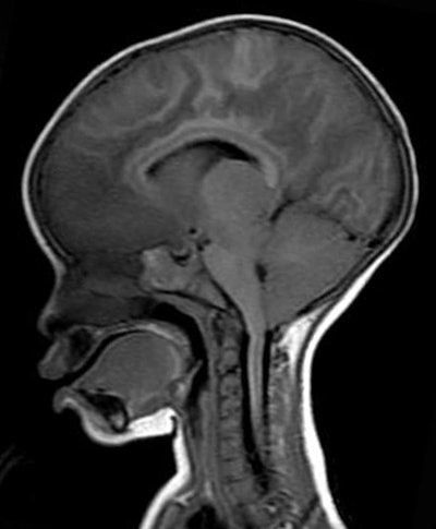 MR image shows increased brain volume in a 19-month-old girl with retinopathy-positive cerebral malaria.