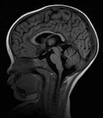 MRI shows normal brain volume in a 14-month-old girl at one-month follow-up. Images courtesy of Michigan State University and GE Healthcare.