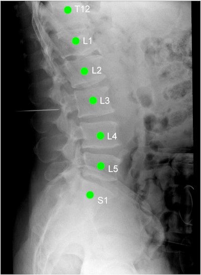 X-ray image of the thoracolumbar spine acquired during spinal surgery. The green labels are automatically applied by the LevelCheck algorithm as a decision-support aid and an independent check on target localization. Image courtesy of Jeffrey Siewerdsen, PhD.