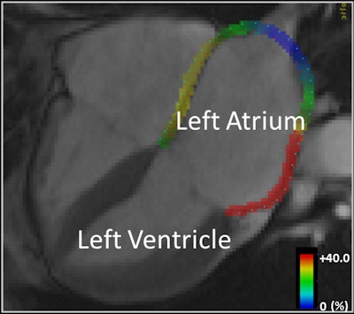 Motion-tracking MRI shows the heart wall of the left atrium highlighted in color (representing 0% to 40%) based on how much it has stretched from baseline. Image courtesy of Dr. Hiroshi Ashikaga, PhD.