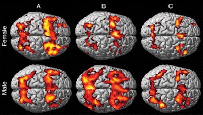 The images show increased activation in bilateral frontal and parietal regions, which is consistent with activation of working memory circuitry in each group. In control subjects (A), visual comparison of working memory activation patterns shows more activation in women than in men, especially in the frontal region. There is substantially less activation (hypoactivation) in female patients with MTBI (B) than in female control subjects, as well as substantially more activation (hyperactivation) in male patients with MTBI than in male control subjects. At the six-week follow-up study (C), female patients with MTBI showed persistent hypoactivation patterns, whereas male MTBI patients showed regression of hyperactivation and activation levels similar to those of male control subjects. Image courtesy of Radiology.