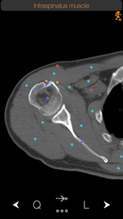 Normal infraspinatus muscle as shown on the CT Anatomy iOS app. Users can tap the dots for more information about each specific anatomical area. All images courtesy of iCat.