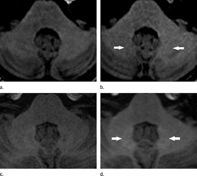 Unenhanced T1-weighted MRI shows hyperintensities in the dentate nucleus (arrows). Images were acquired before (a) and after (b) six administrations of gadopentetate dimeglumine and before (c) and after (d) six administrations of gadoterate meglumine. Images courtesy of Radiology.