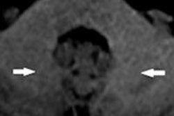 2015 05 04 17 43 35 523 Dentate Gado Radburch Radiology 400 20150505004605
