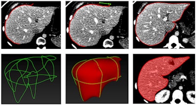 Stages of CT-based semiautomated liver segmentation. Image courtesy of Dr. An Tang.