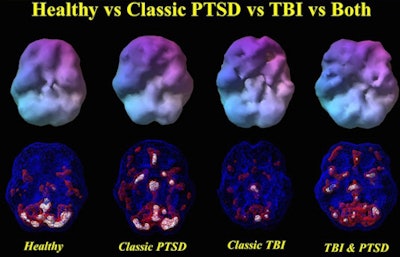 SPECT images show the differences between a healthy person and veterans with PTSD, TBI, or both disorders. The veteran with PTSD shows increased perfusion, particularly in the frontal lobes. The veteran with TBI shows decreased perfusion throughout the same brain region. A veteran with both PTSD and TBI has perfusion that is intermediate -- lower than in the person with PTSD, but higher than in the individual with TBI. Image courtesy of Dr. Cyrus Raji.