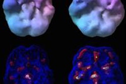 2015 05 06 16 13 04 846 Ptsd Tbi Spect Raji 450 20150506232016