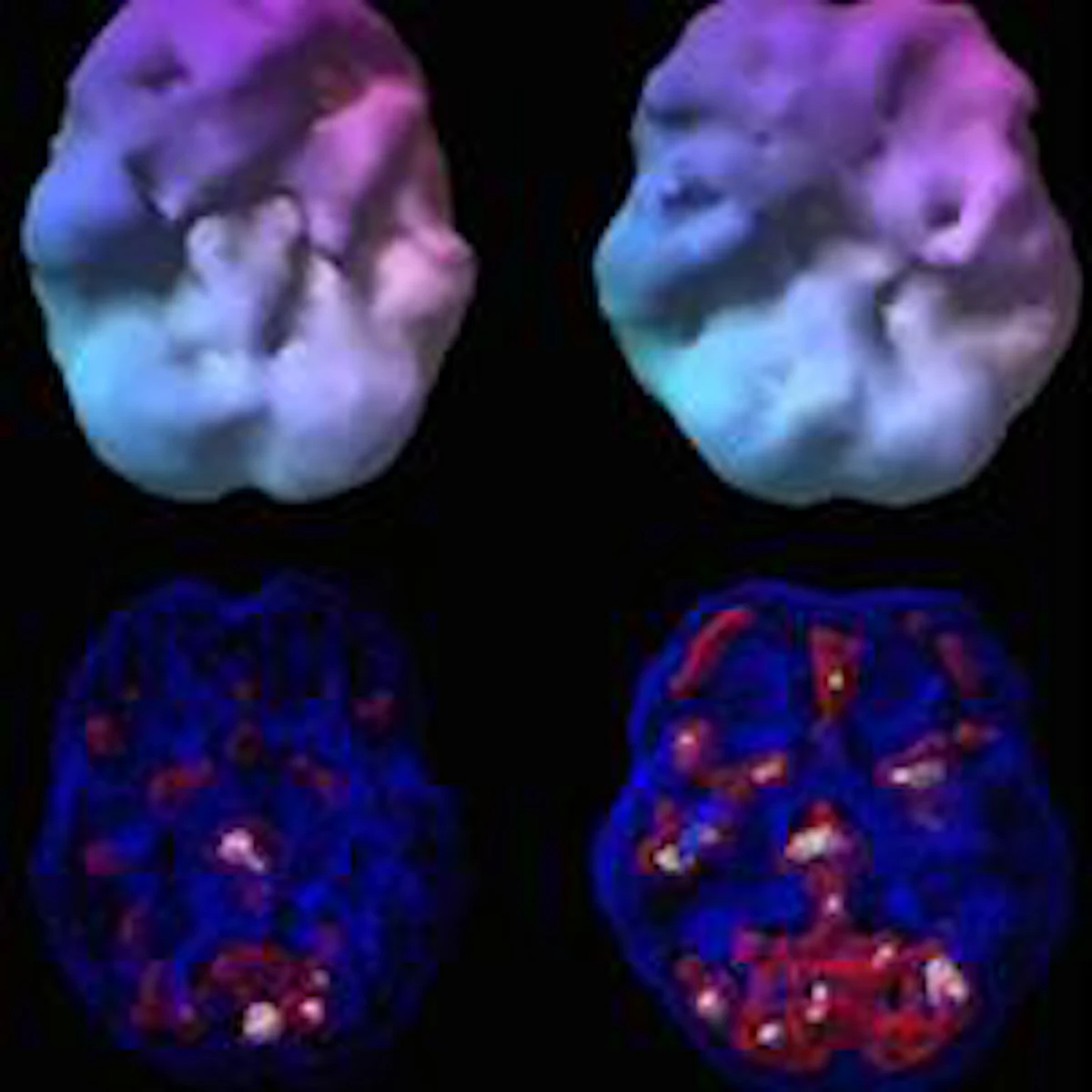 SPECT differentiates PTSD from TBI in military veterans | AuntMinnie