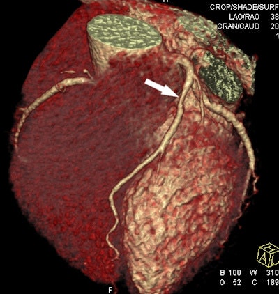 66-year-old male with suspected coronary artery disease. 50% stenosis in the left anterior descending (LAD) artery is seen at CTA (above) and digital subtraction angiography (below). Images courtesy of Dr. Long Jiang Zhang, PhD.